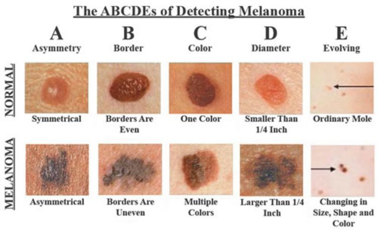 skin_cancer
