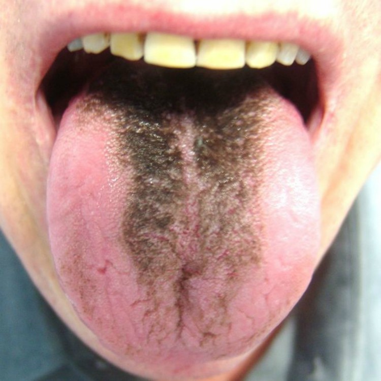Black coating on tongue.