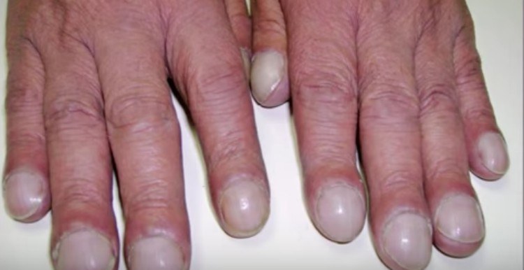 clubbed nails