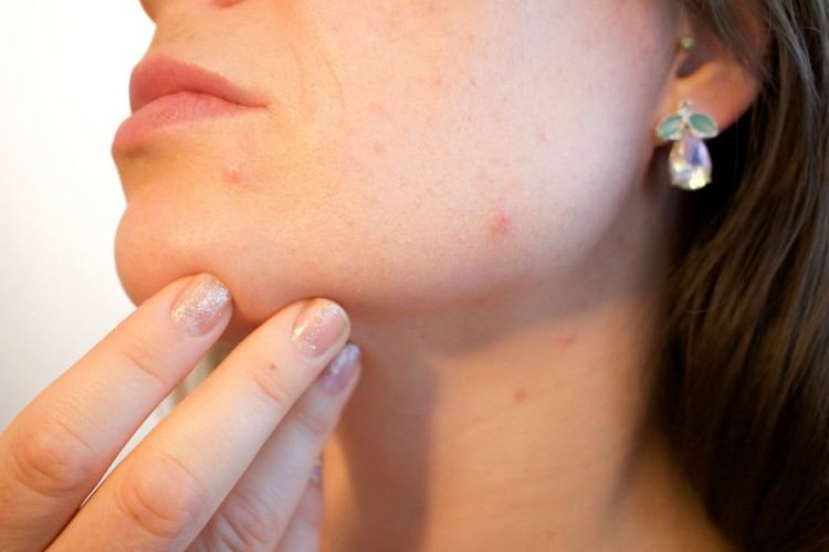 Image of zit on chin.