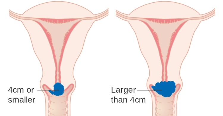 Comparison of healthy and unhealthy cervix.