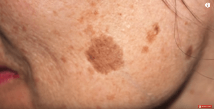 Why do we get facial brown spots and how can we get rid of them