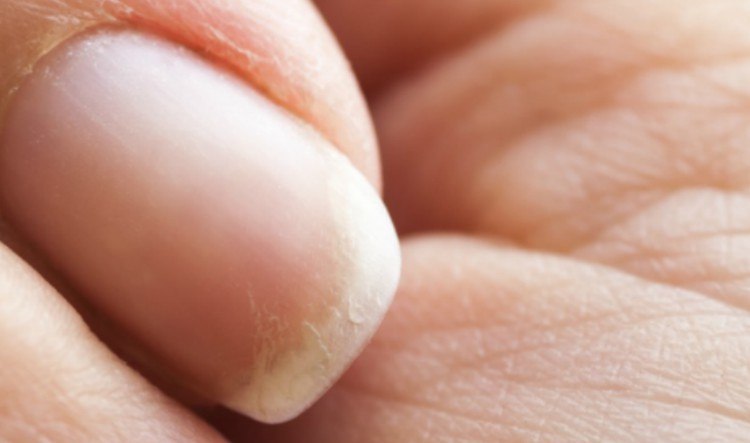 brittle nails