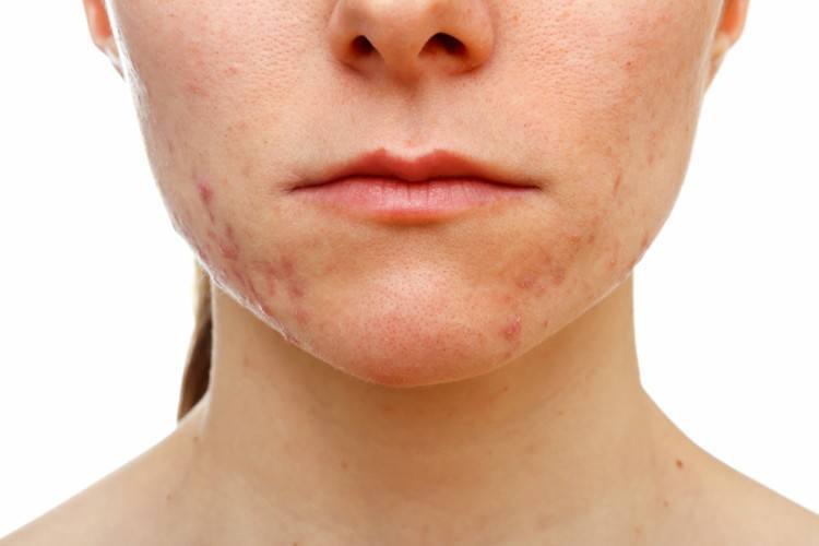 Girl With Acne