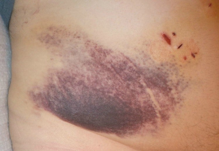 vicks for bruise