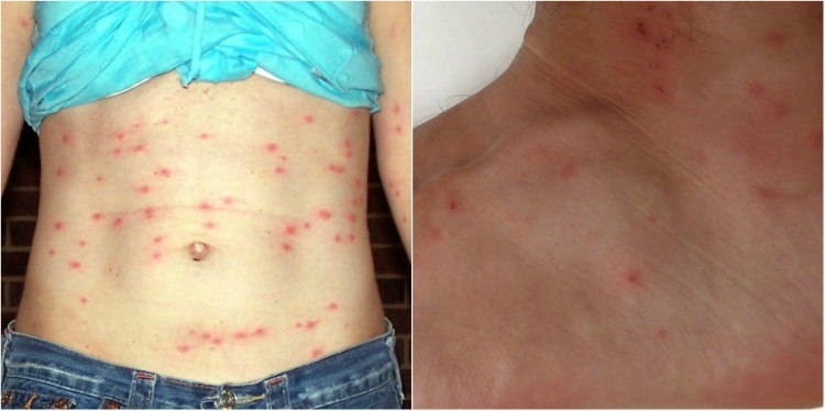 chiggers-collage