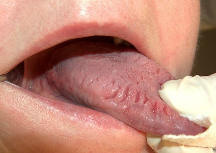 Tongue with cracks in it.