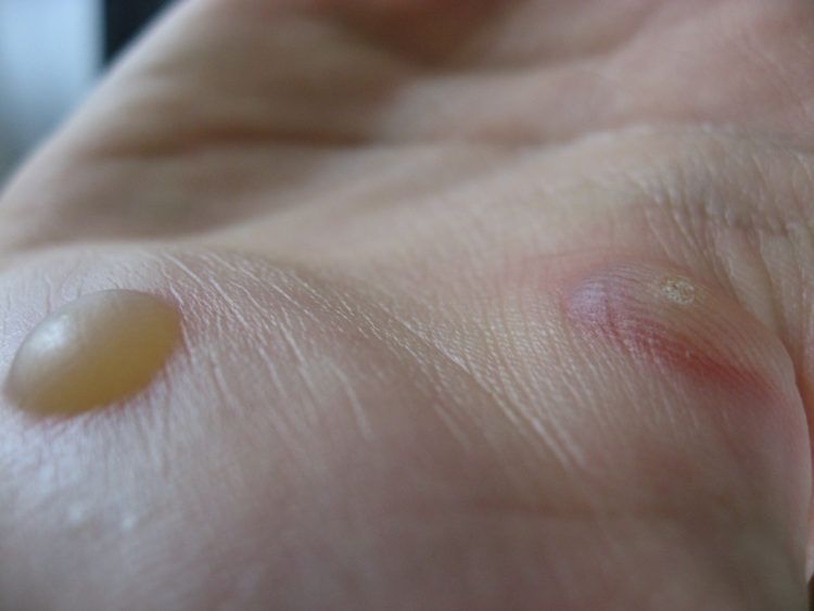 Two warts on hand.