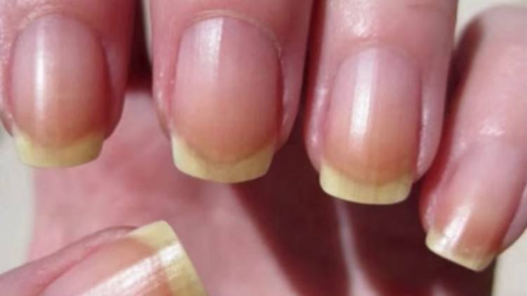 yellow nails