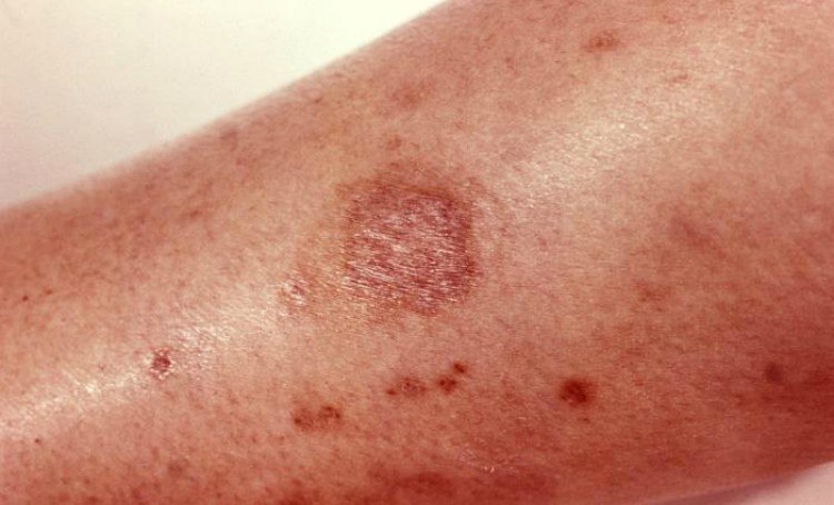 brown recluse bite