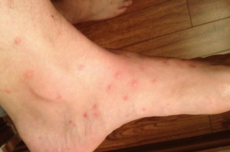 flea bites