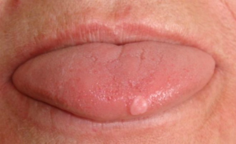 Sore on tongue.