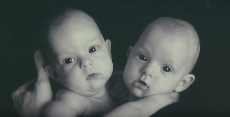 Black and white picture of the young conjoined twins.