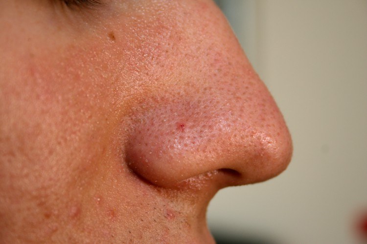 Nose with blackheads on it.