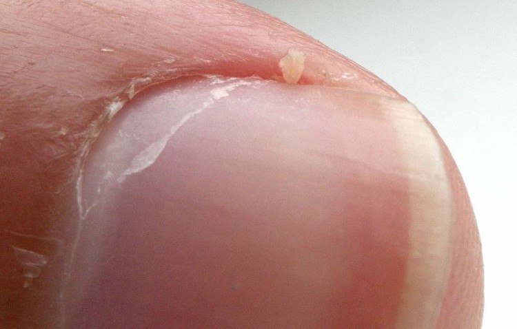 hangnail close-up