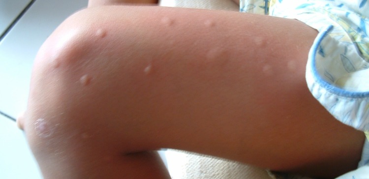 mosquito bites