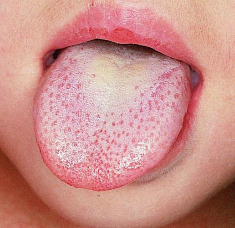 Tongue with white on it.