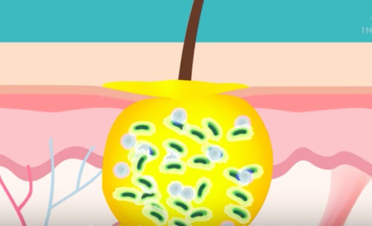 pimple forming under the skin